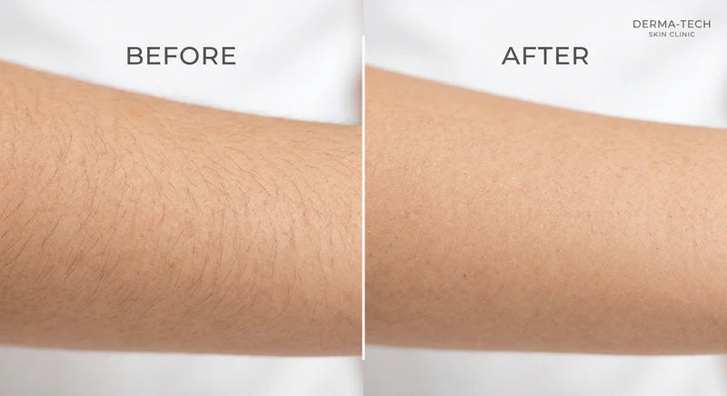 Before and after results of 12 weeks bikini line hair removal with Lume Glows IPL